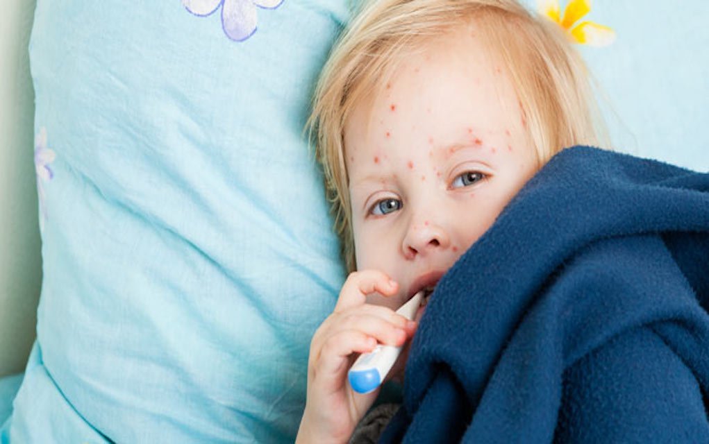 Here’s Everything You Need to Know About Chickenpox